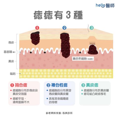 臉突然長痣|痣變大、痣多或長毛會變皮膚癌？認識痣的形成與原因